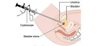 cystolithotripsy