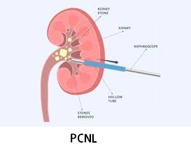 pcnl